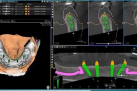 Chirurgia Implantare Guidata: Precisione e Innovazione nell’Implantologia