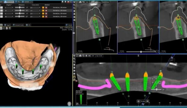 Chirurgia Implantare Guidata: Precisione e Innovazione nell’Implantologia